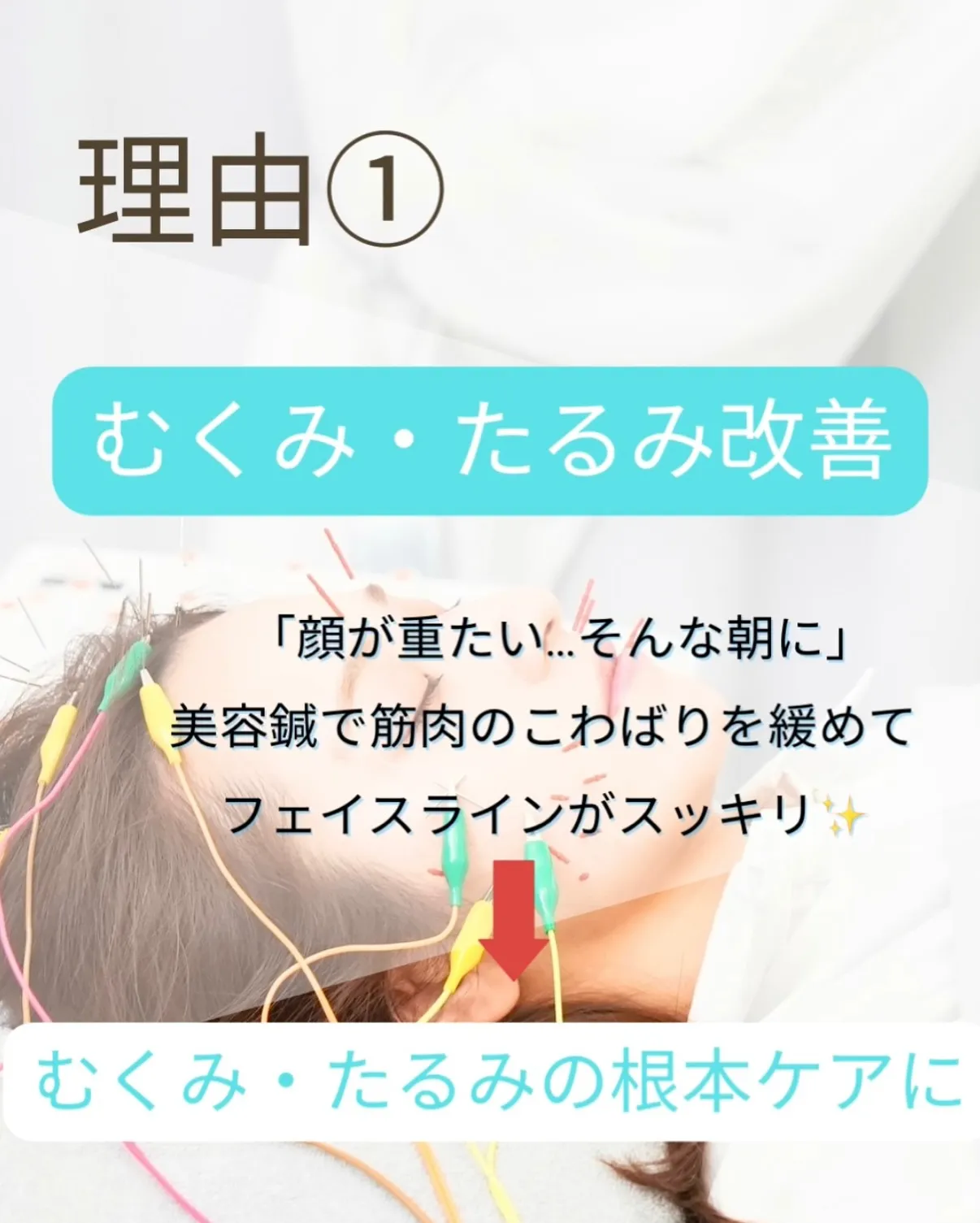 \美容鍼って、なんで人気なの?🪡✨/