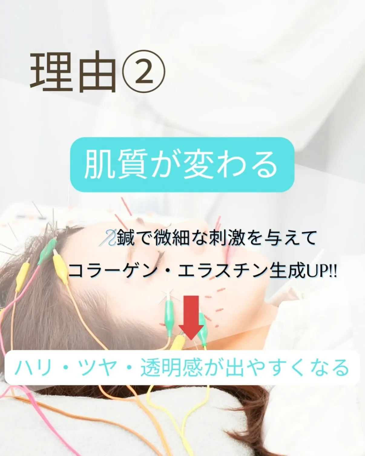 \美容鍼って、なんで人気なの?🪡✨/