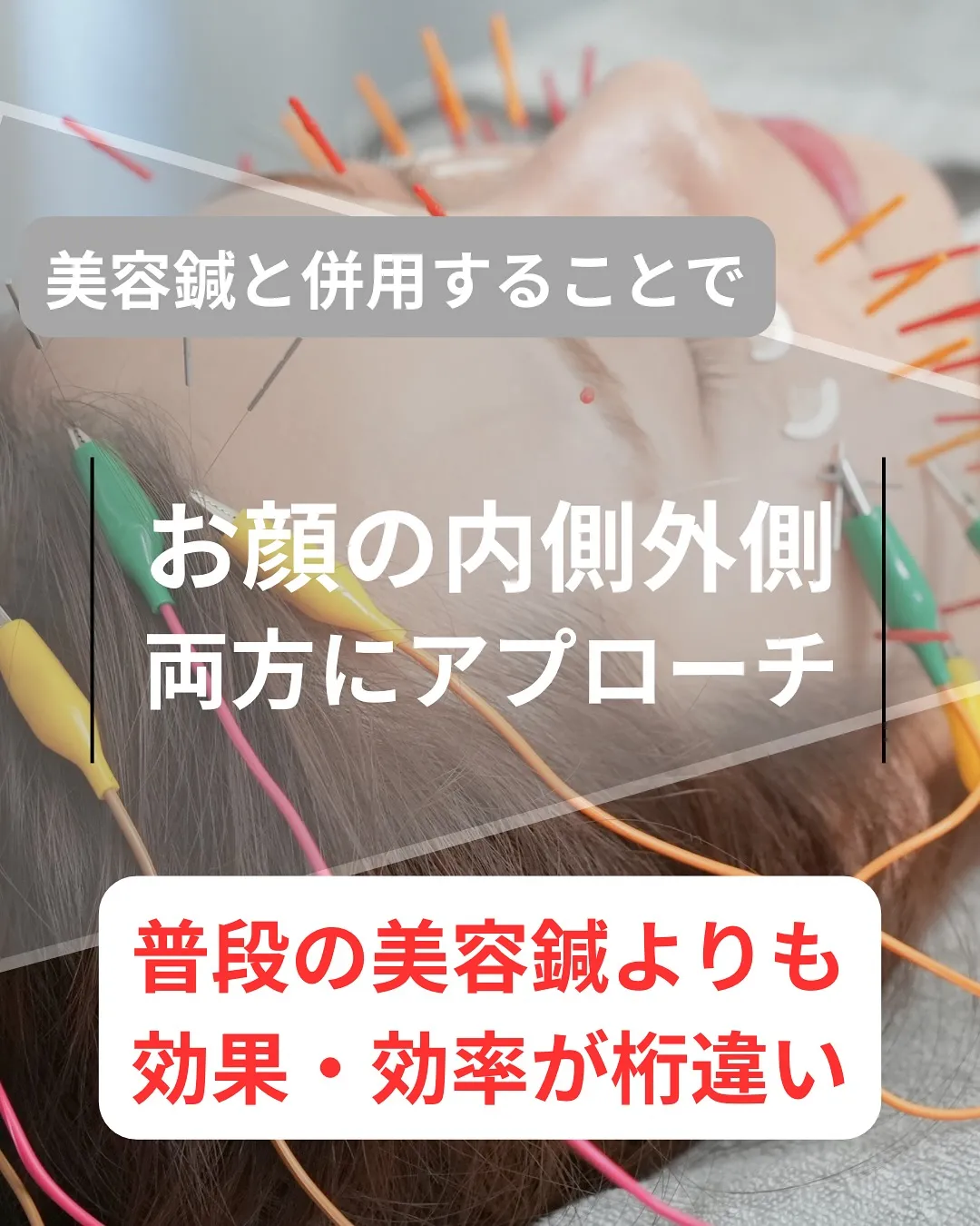 【韓国LED “omega PDT”で肌質改善】