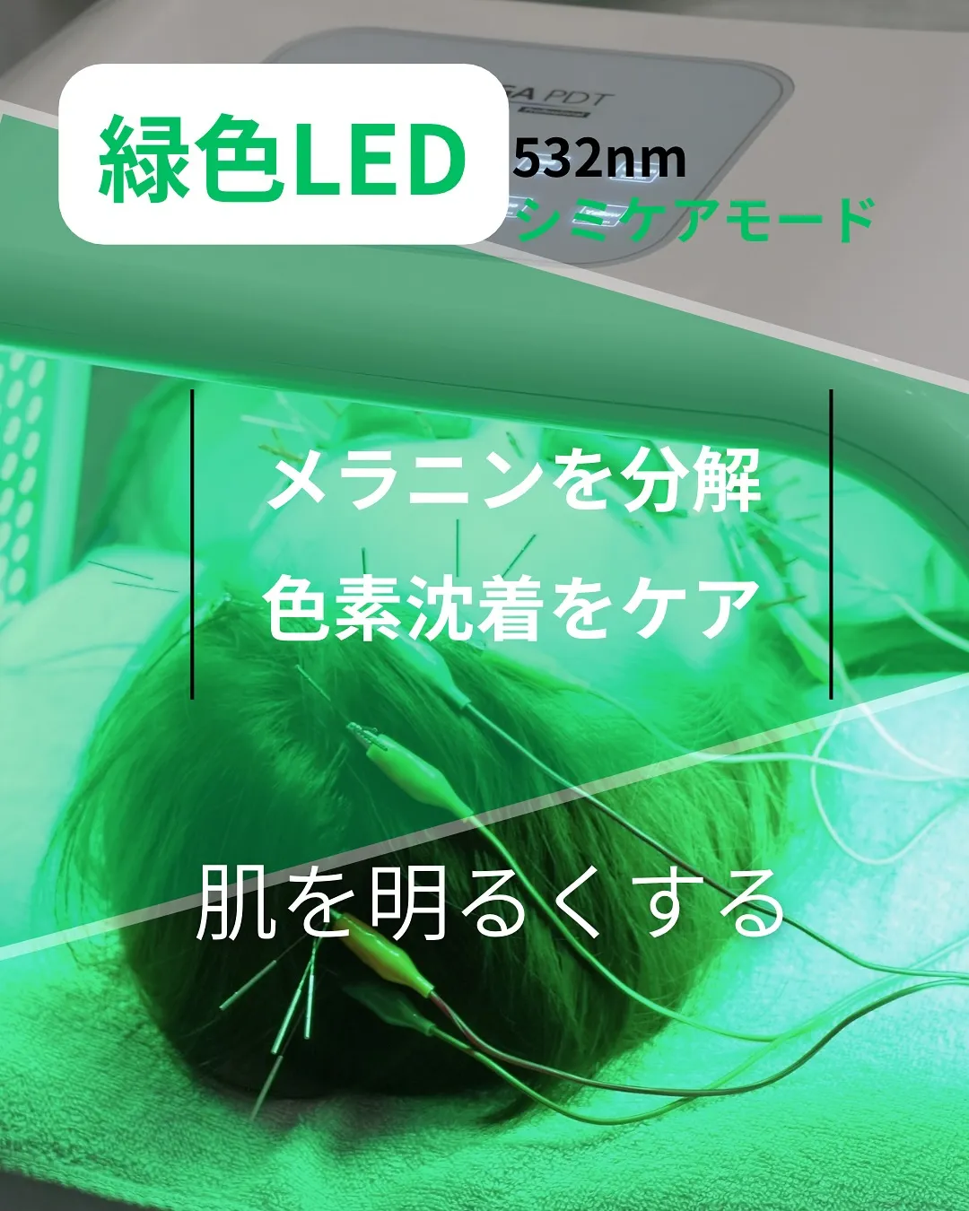 【韓国LED “omega PDT”で肌質改善】