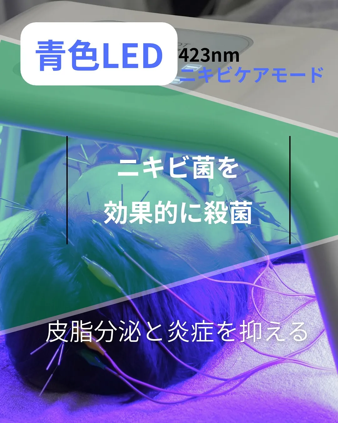 【韓国LED “omega PDT”で肌質改善】