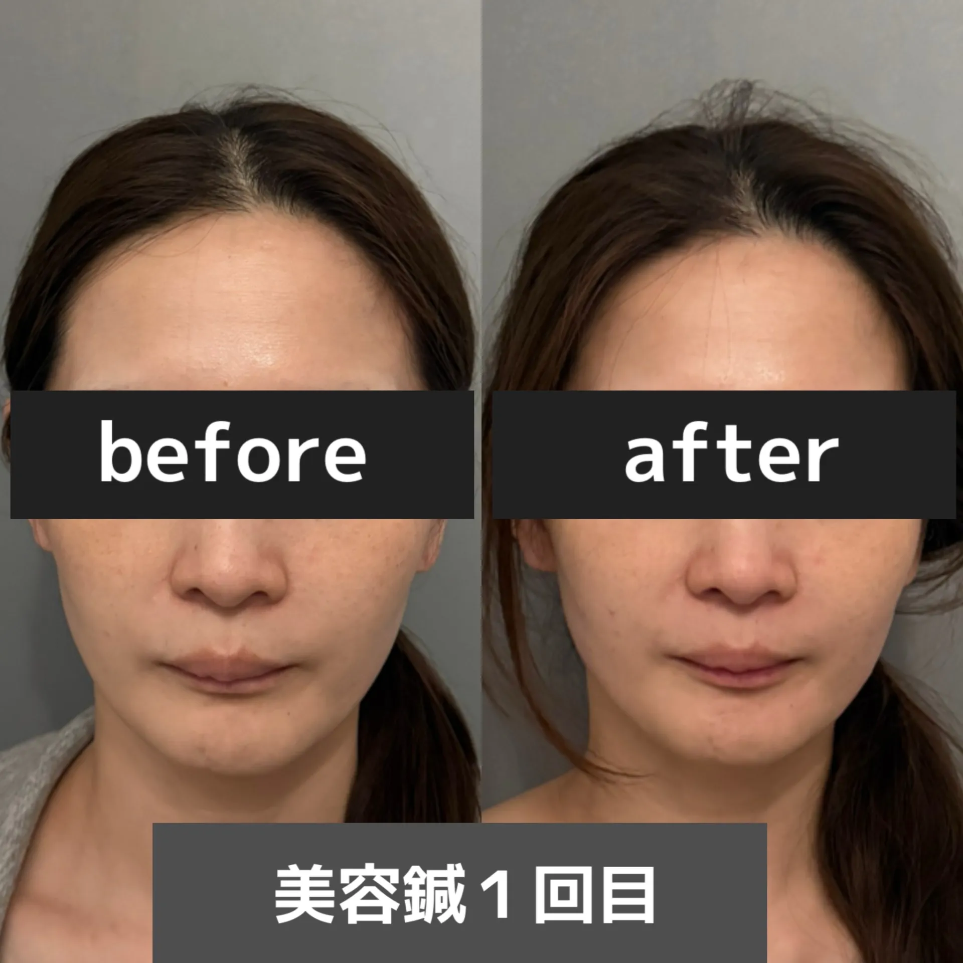 住吉区長居エリアで美容鍼