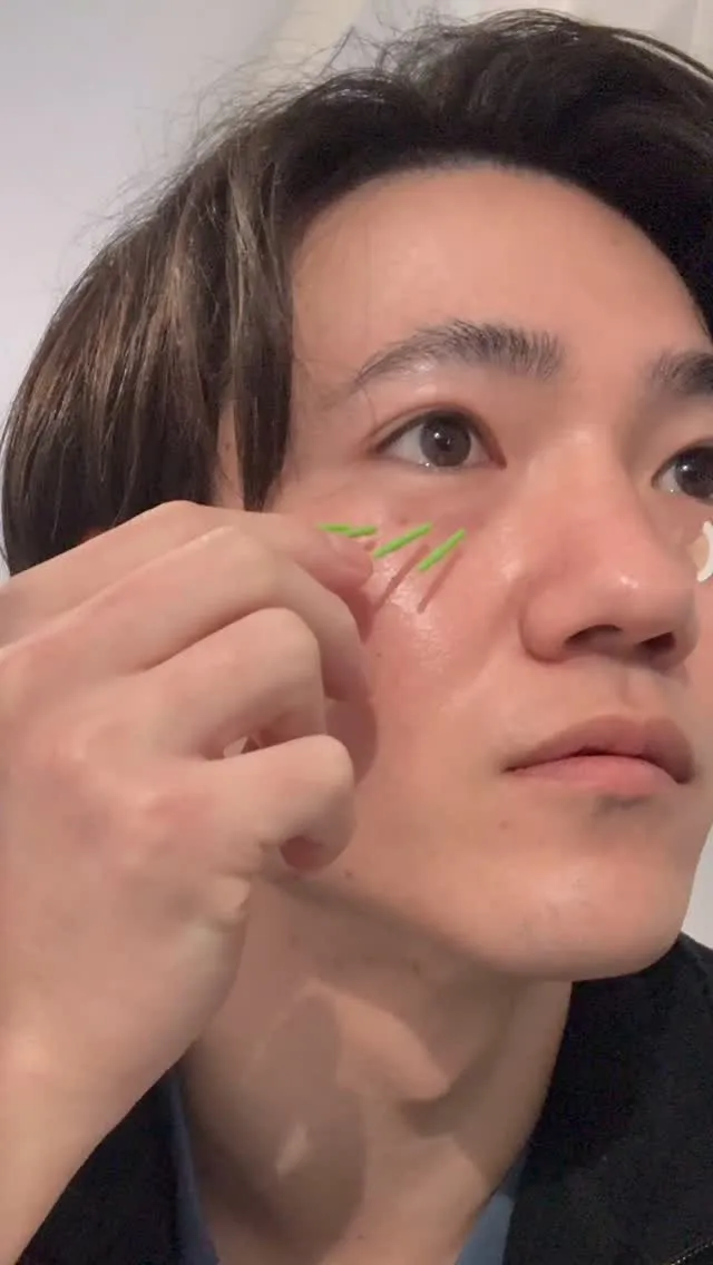 目のたるみ・クマに美容鍼🪡